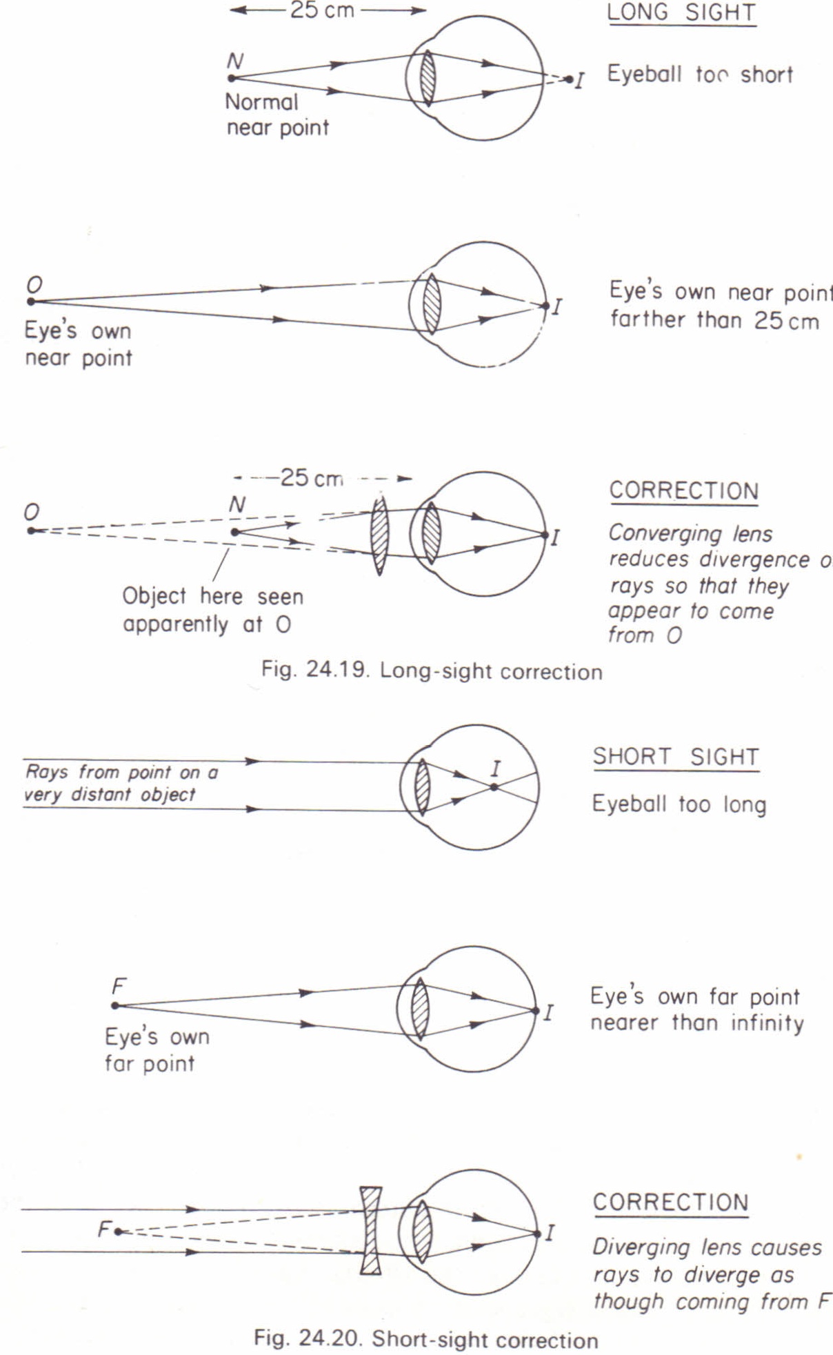 Eye Defects Diagram